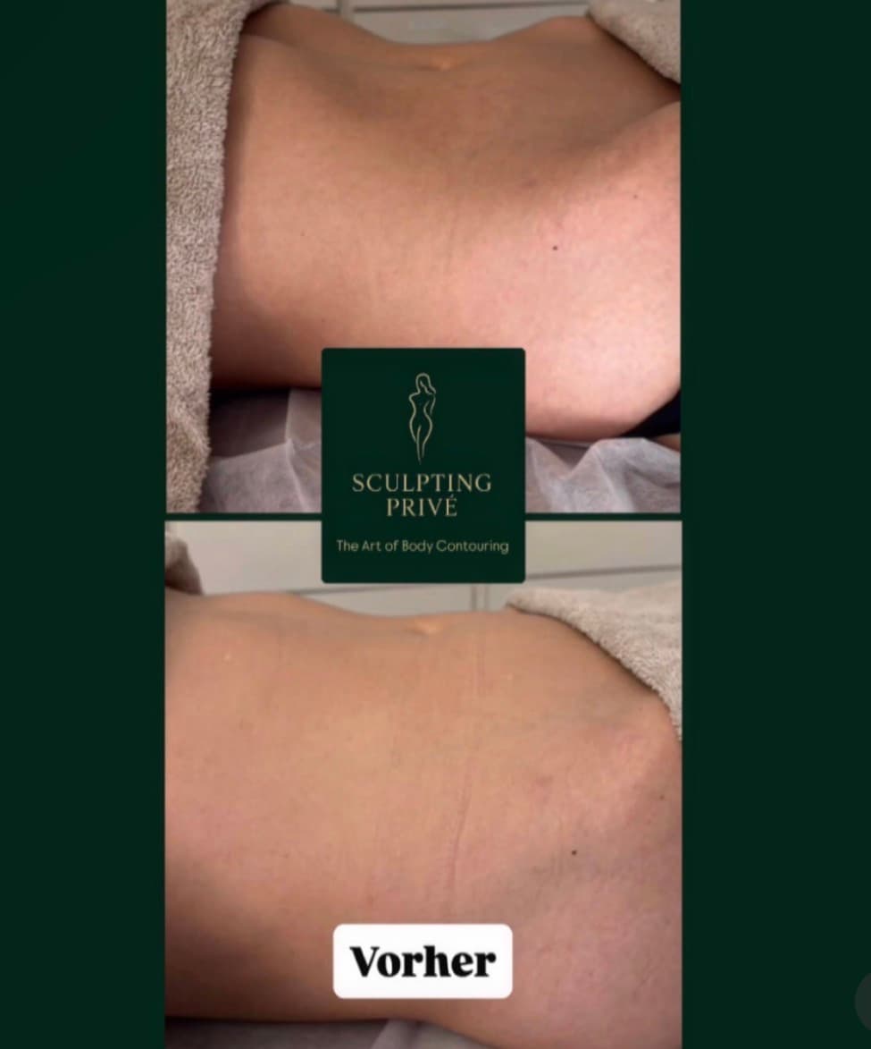 Ergebnis einer brasilianischen Lymphdrainage, Beispiel 1