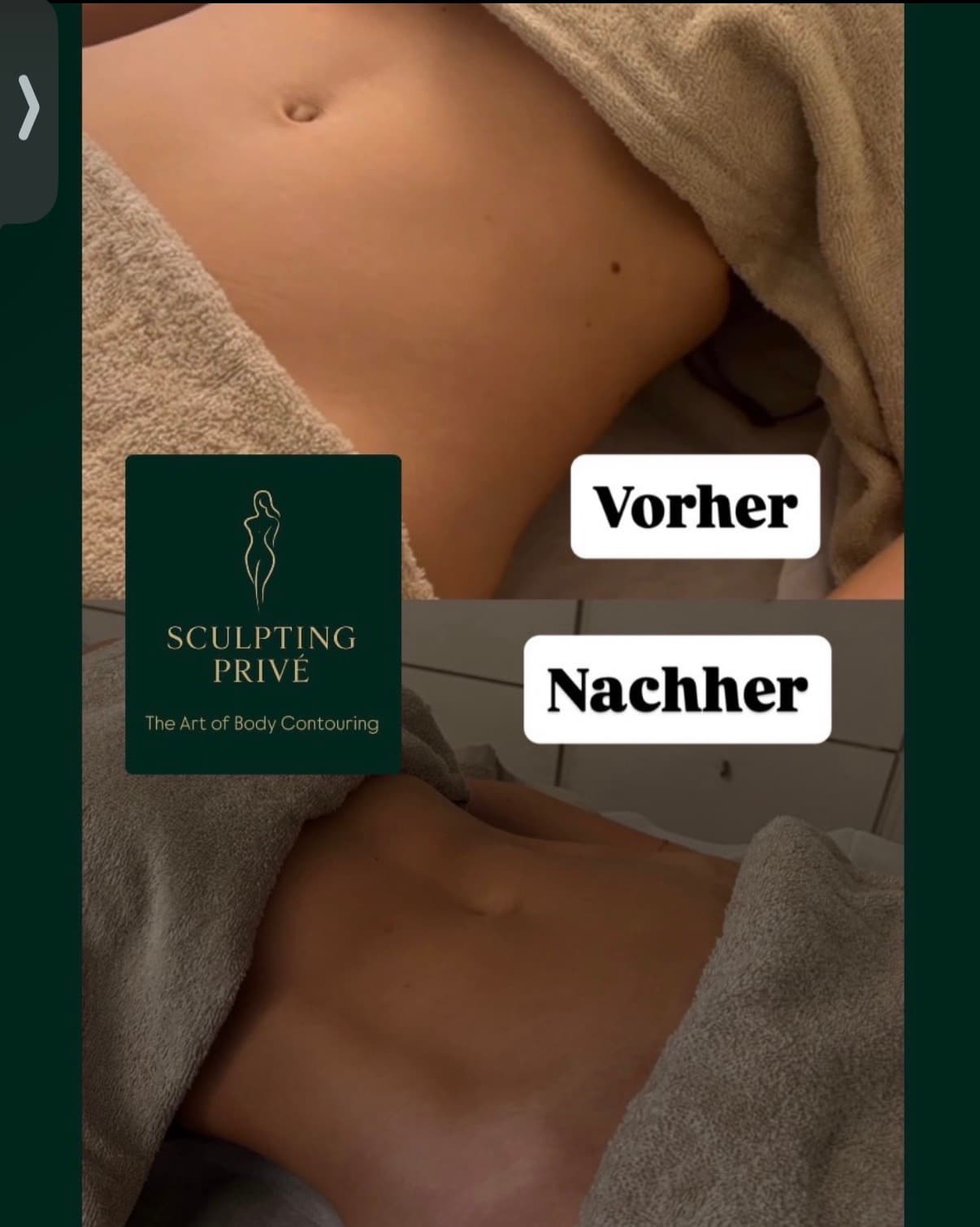 Ergebnis einer brasilianischen Lymphdrainage, Beispiel 3
