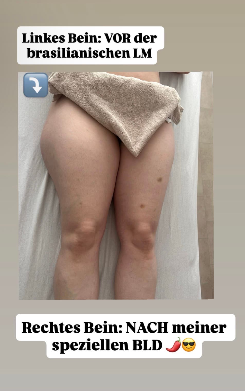Ergebnis einer brasilianischen Lymphdrainage, Beispiel 4