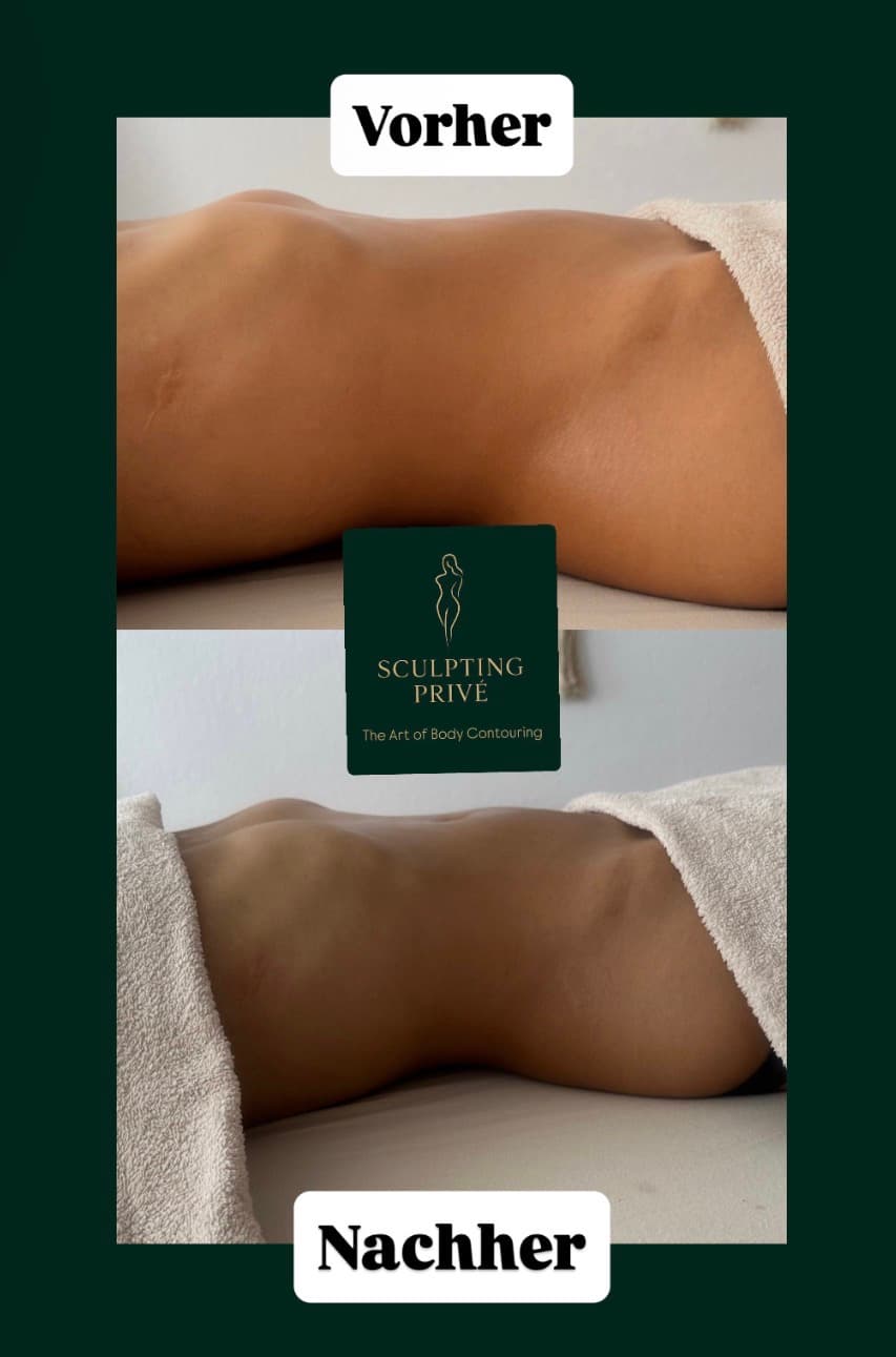 Ergebnis einer brasilianischen Lymphdrainage, Beispiel 5